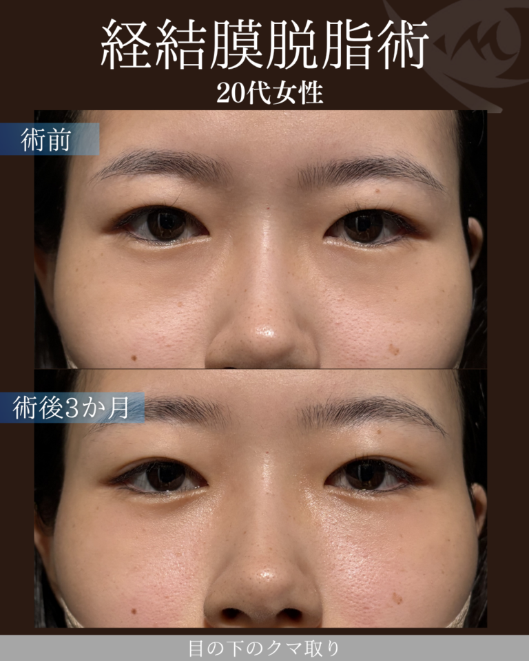 20代女性　経結膜脱脂術